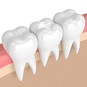 dental sealant on molar tooth