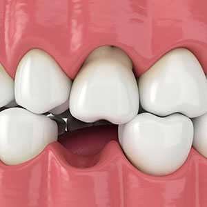 progression of periodontal disease
