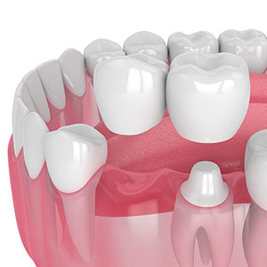 dental crown with adjacent bridge
