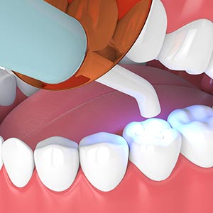 composite dental filling