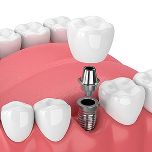 single dental implant and crown