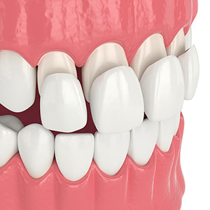 dental veneers on front teeth